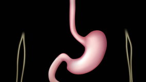 Roux-en-Y Gastric Bypass (RNY) surgery procedure